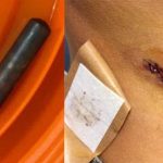 chip implantat