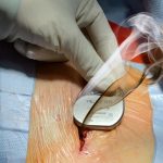 kabelbrand im Herzschrittmacher